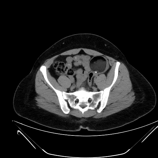 File:Bilateral ovarian mature cystic teratomas (Radiopaedia 79373-92457 Axial non-contrast 52).jpg