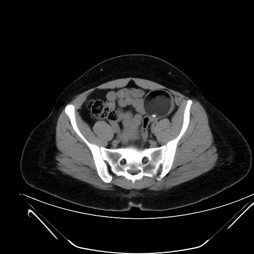 Bilateral ovarian mature cystic teratomas (Radiopaedia 79373-92457 Axial non-contrast 53).jpg