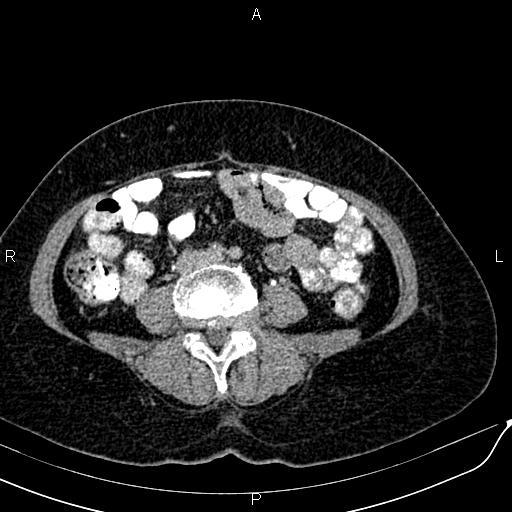 Bilateral ovarian serous cystadenocarcinoma (Radiopaedia 86062-101989 Axial C+ delayed 44).jpg