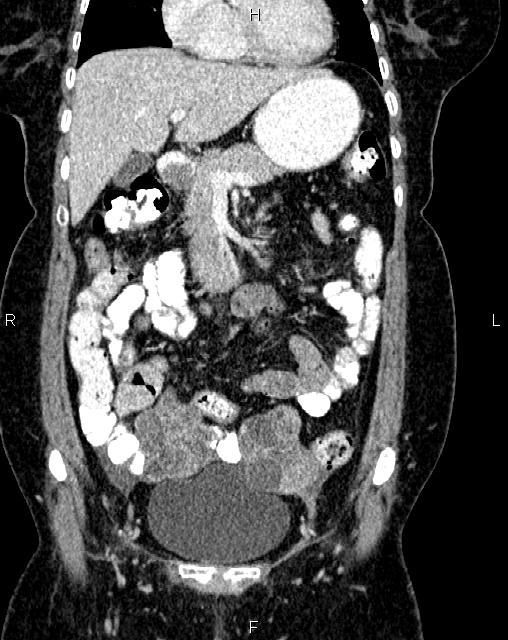 Bilateral ovarian serous cystadenocarcinoma (Radiopaedia 86062-101989 D 12).jpg