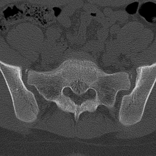 Bilateral pars defect (Radiopaedia 26691-26846 Axial bone window 82).jpg