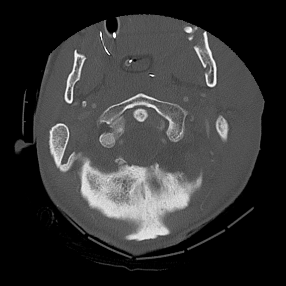File:Bilateral perched facets with cord injury (Radiopaedia 45587-49713 Axial bone window 24).jpg
