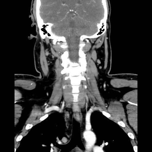Bilateral peritonsillar abscess (Radiopaedia 85065-100610 Coronal 50).jpg