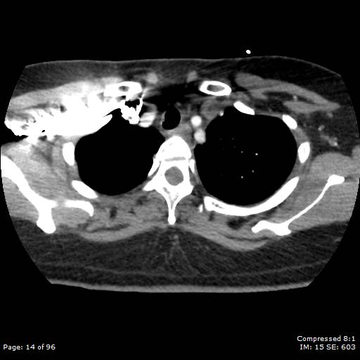 File:Bilateral pulmonary emboli with Hampton hump sign (Radiopaedia 54070-60246 Axial C+ CTPA 11).jpg