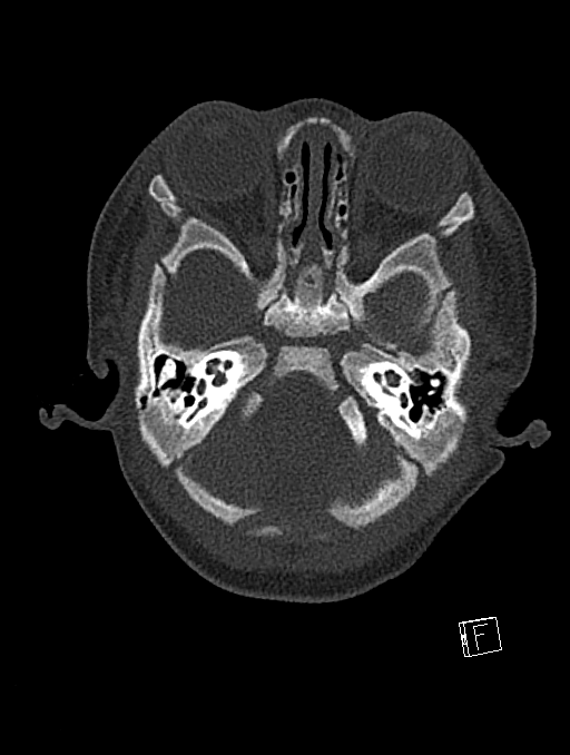 Bilateral subdural hemorrhage and parietal skull fracture (Radiopaedia 26058-26192 Axial bone window 109).png