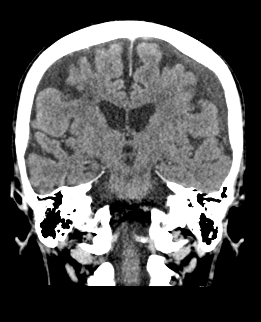 Bilateral subdural hygroma (Radiopaedia 73637-84421 Coronal non-contrast 27).jpg