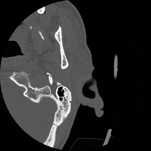 Bilateral temporal bone fractures (Radiopaedia 29482-29970 D 2).jpg