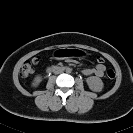 Bilateral ureteric stents (Radiopaedia 48795-53825 Axial non-contrast 30).jpg