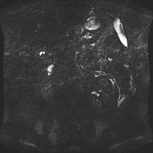 Biliary pancreatitis (Radiopaedia 72289-82824 Coronal 3D T2 80).jpg