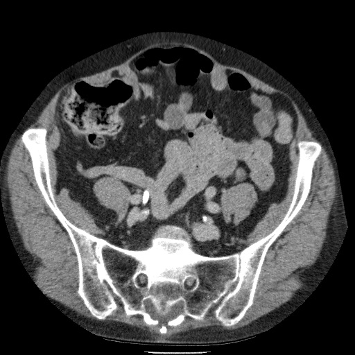 Bladder tumor detected on trauma CT (Radiopaedia 51809-57609 C 100).jpg