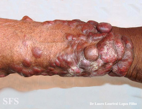Blastomycosis-Keloidal Blastomycosis (Dermatology Atlas 5).jpg