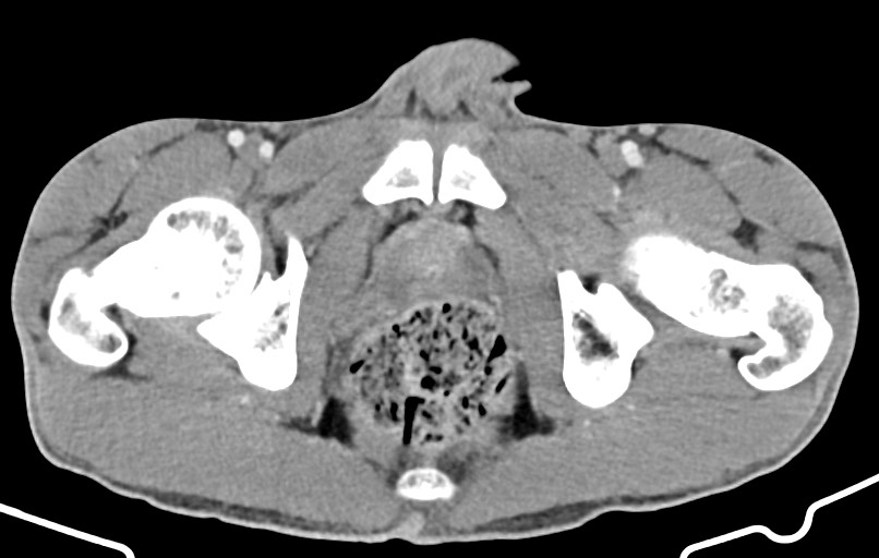 Blunt injury to the small bowel (Radiopaedia 74953-85987 A 193).jpg