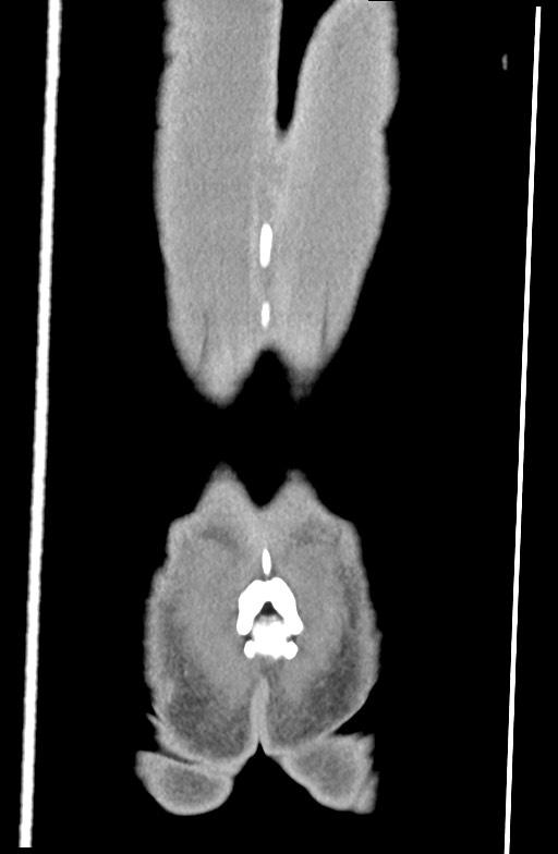 Blunt injury to the small bowel (Radiopaedia 74953-85987 B 93).jpg