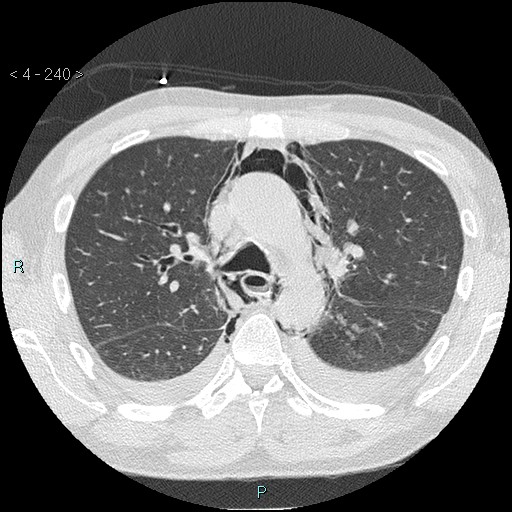 File:Boerhaave syndrome (Radiopaedia 27683-27897 lung window 3).jpg