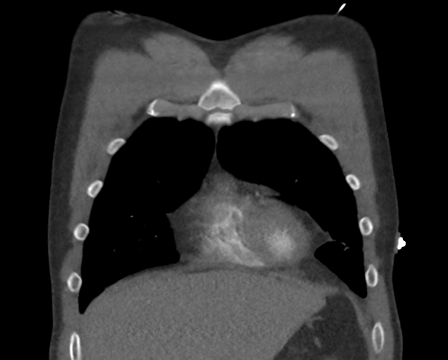 File:Boerhaave syndrome (Radiopaedia 39382-41660 C 21).png