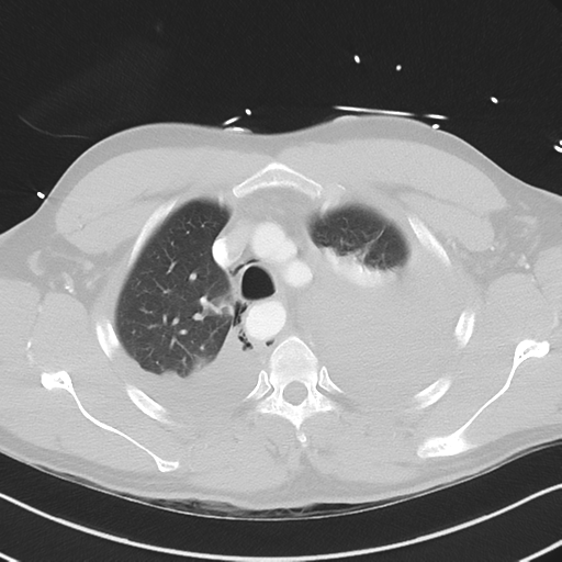 Boerhaave syndrome (Radiopaedia 39382-41661 Axial lung window 14).png