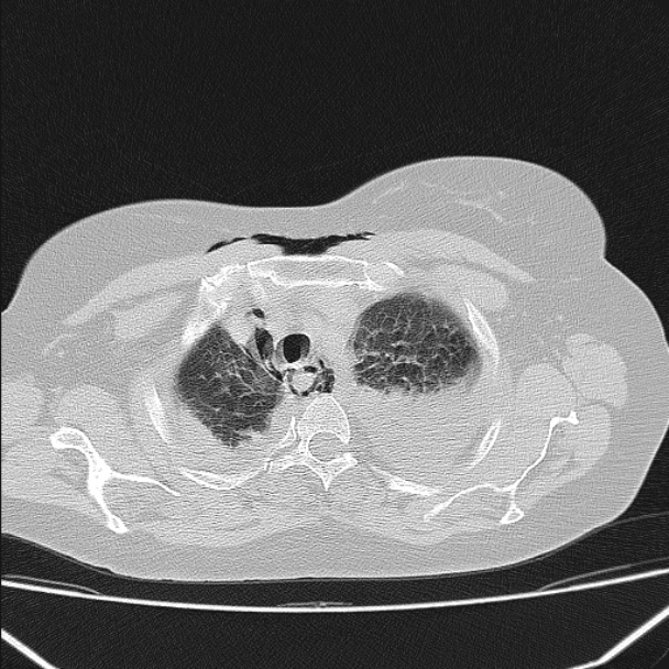 Boerhaave syndrome (Radiopaedia 45644-49799 Axial lung window 39).jpg