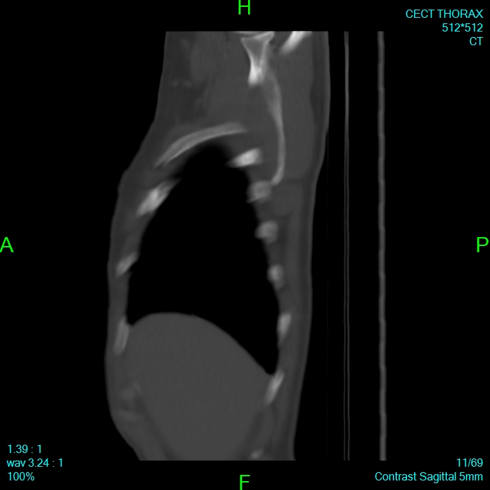Bone metastases from lung carcinoma (Radiopaedia 54703-60937 Sagittal bone window 11).jpg