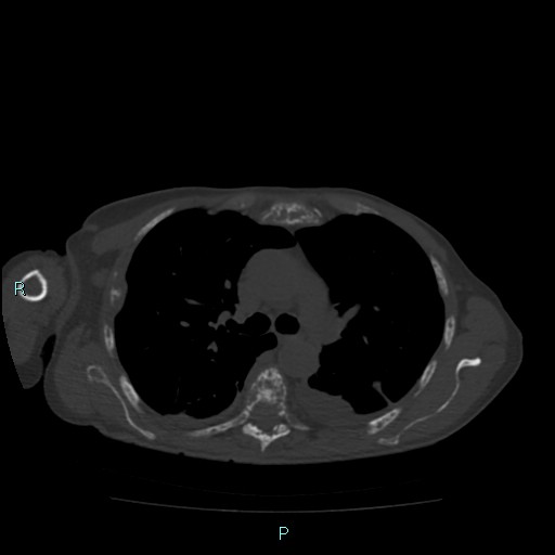 Bone metastases from untreated breast cancer (Radiopaedia 42973-46219 Axial bone window 40).jpg