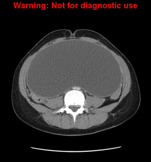 Borderline mucinous cystadenoma of ovary (Radiopaedia 25586-25767 A 47).jpg