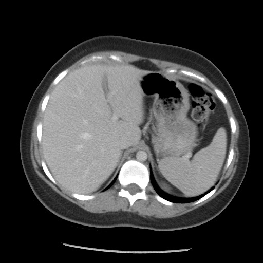 File:Borderline mucinous tumor (ovary) (Radiopaedia 78228-90808 A 71).jpg