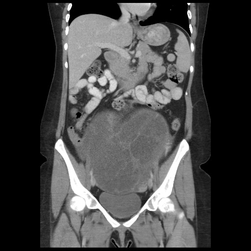 Borderline mucinous tumor (ovary) (Radiopaedia 78228-90808 C 26).jpg