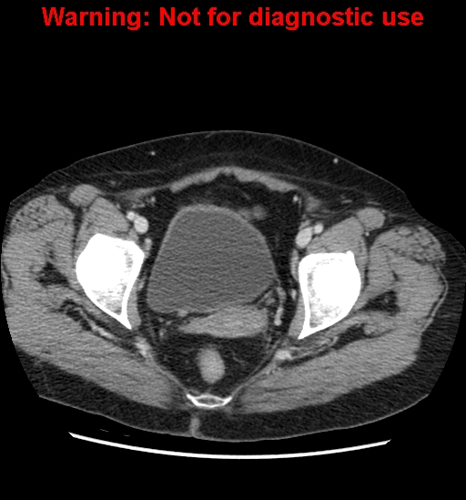 File:Bosniak renal cyst - type II (Radiopaedia 23404-23468 D 67).jpg