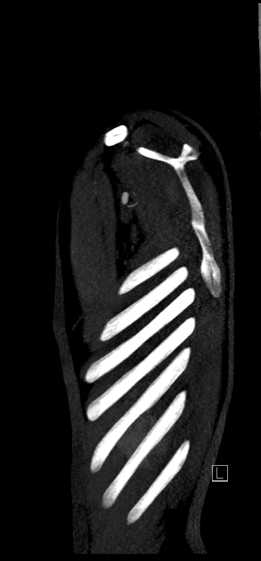 Brachiocephalic trunk pseudoaneurysm (Radiopaedia 70978-81191 C 89).jpg