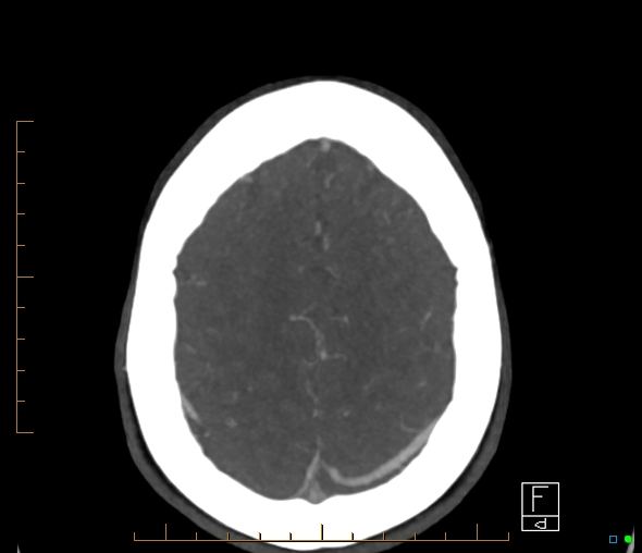 Brachiocephalic trunk stenosis (Radiopaedia 87242-103519 A 12).jpg