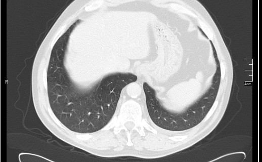 Brain metastases from squamocellular lung cancer (Radiopaedia 56515-63219 Axial lung window 54).jpg