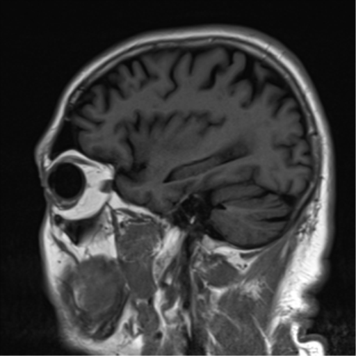 File:Brain metastasis (large cystic mass) (Radiopaedia 47497-52107 Sagittal T1 21).png