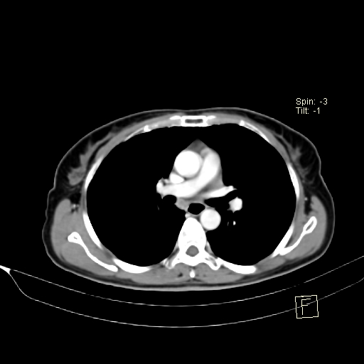 Brain metastasis as initial presentation of non-small cell lung cancer (Radiopaedia 65122-74127 A 22).jpg