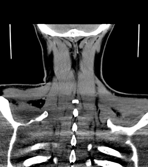 File:Branchial cleft cyst (Radiopaedia 31167-31875 Coronal C+ delayed 55).jpg