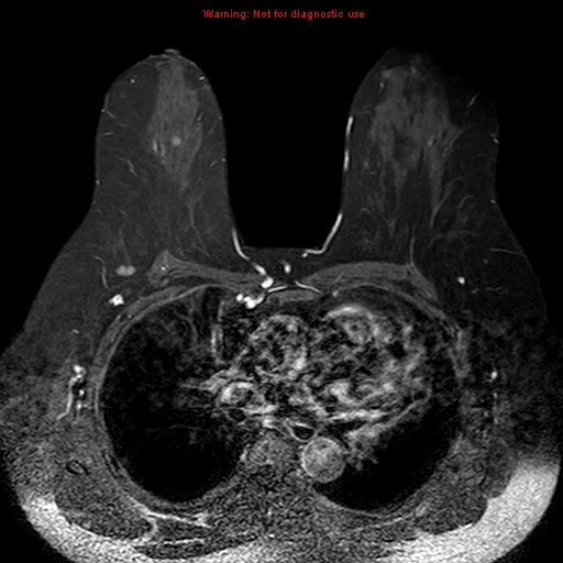 File:Breast carcinoma (multicentric multifocal in mammary Paget disease) (Radiopaedia 50966-56512 Axial T1 C+ fat sat 10).jpg