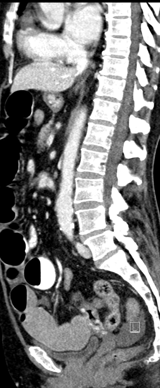 Broad ligament hernia (Radiopaedia 84802-100276 C 37).jpg