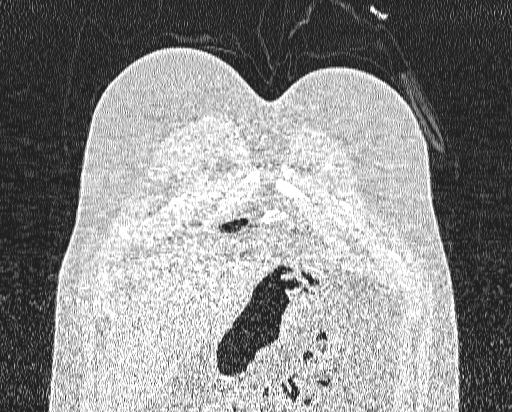 Bronchial atresia (Radiopaedia 58271-65417 Coronal lung window 1).jpg