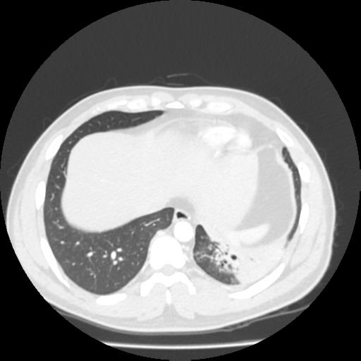 Bronchial carcinoid (Radiopaedia 80013-93291 Axial lung window 102).jpg
