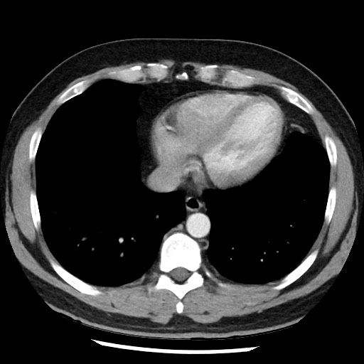 Bronchial carcinoid tumor (Radiopaedia 67377-76764 A 45).jpg