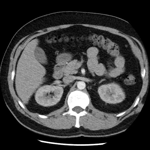 Bronchial carcinoid tumor (Radiopaedia 67377-76764 A 69).jpg