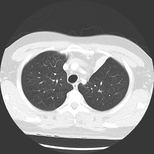 Bronchial carcinoid tumor (Radiopaedia 67377-76764 Axial lung window 18).jpg