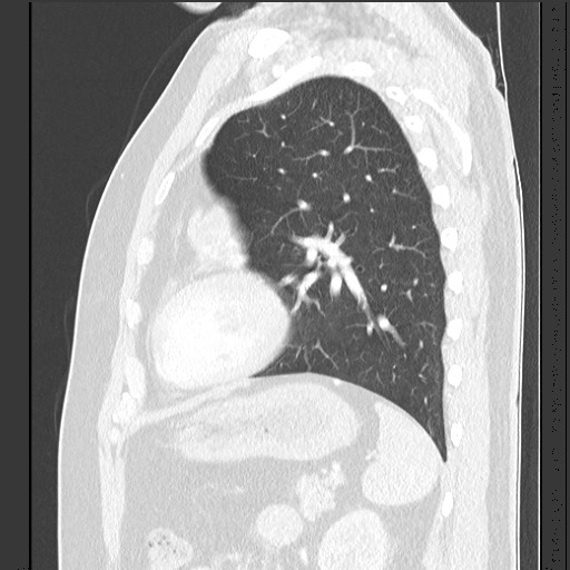 Bronchial carcinoid tumor (Radiopaedia 67377-76764 Sagittal lung window 50).jpg