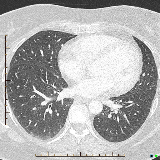 File:Bronchial diverticula (Radiopaedia 79512-92676 Axial lung window 124).jpg