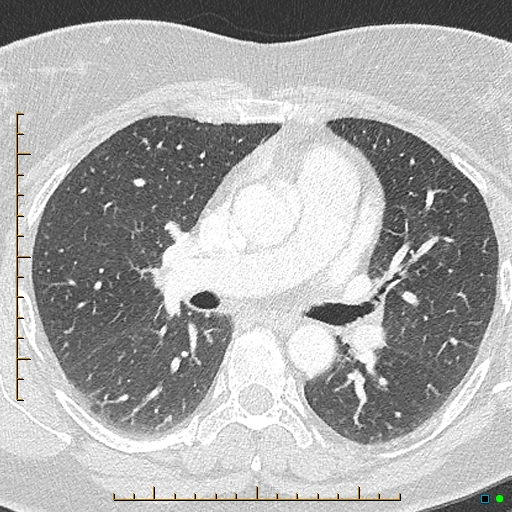 File:Bronchial diverticula (Radiopaedia 79512-92676 Axial lung window 87).jpg