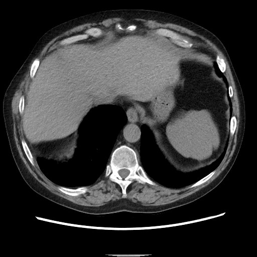 Bronchial stenosis - lung transplant (Radiopaedia 73133-83848 Axial non-contrast 51).jpg