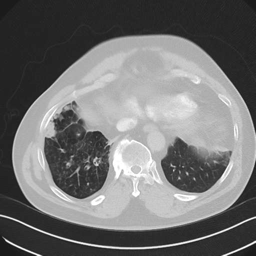 File:Bronchiectasis (Radiopaedia 39385-41666 Axial lung window 51).png