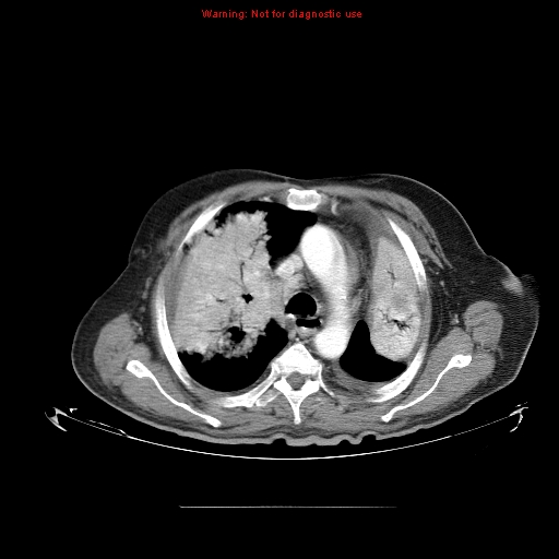 File:Bronchioloalveolar carcinoma (Radiopaedia 9272-9955 A 10).jpg