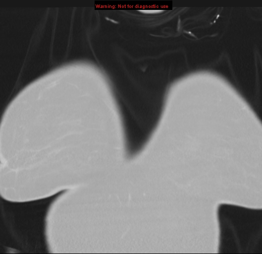 Bronchoalveolar carcinoma (BAC) (Radiopaedia 13436-13392 Coronal lung window 1).jpg