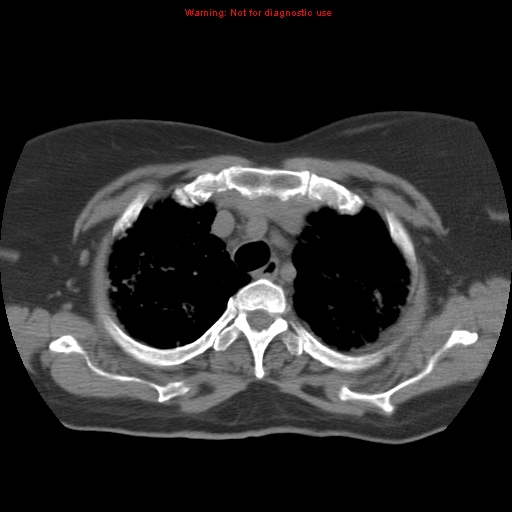 Bronchoalveolar carcinoma (Radiopaedia 13224-13233 Axial non-contrast 11).jpg