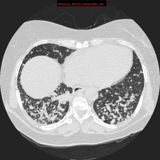 File:Bronchoalveolar carcinoma (Radiopaedia 13224-13233 B 7).jpg