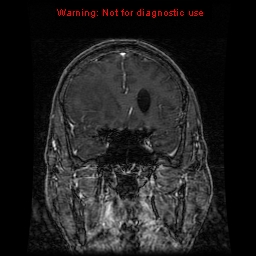 File:Bronchogenic carcinoma brain metastasis (Radiopaedia 9286-9969 Coronal T1 31).jpg